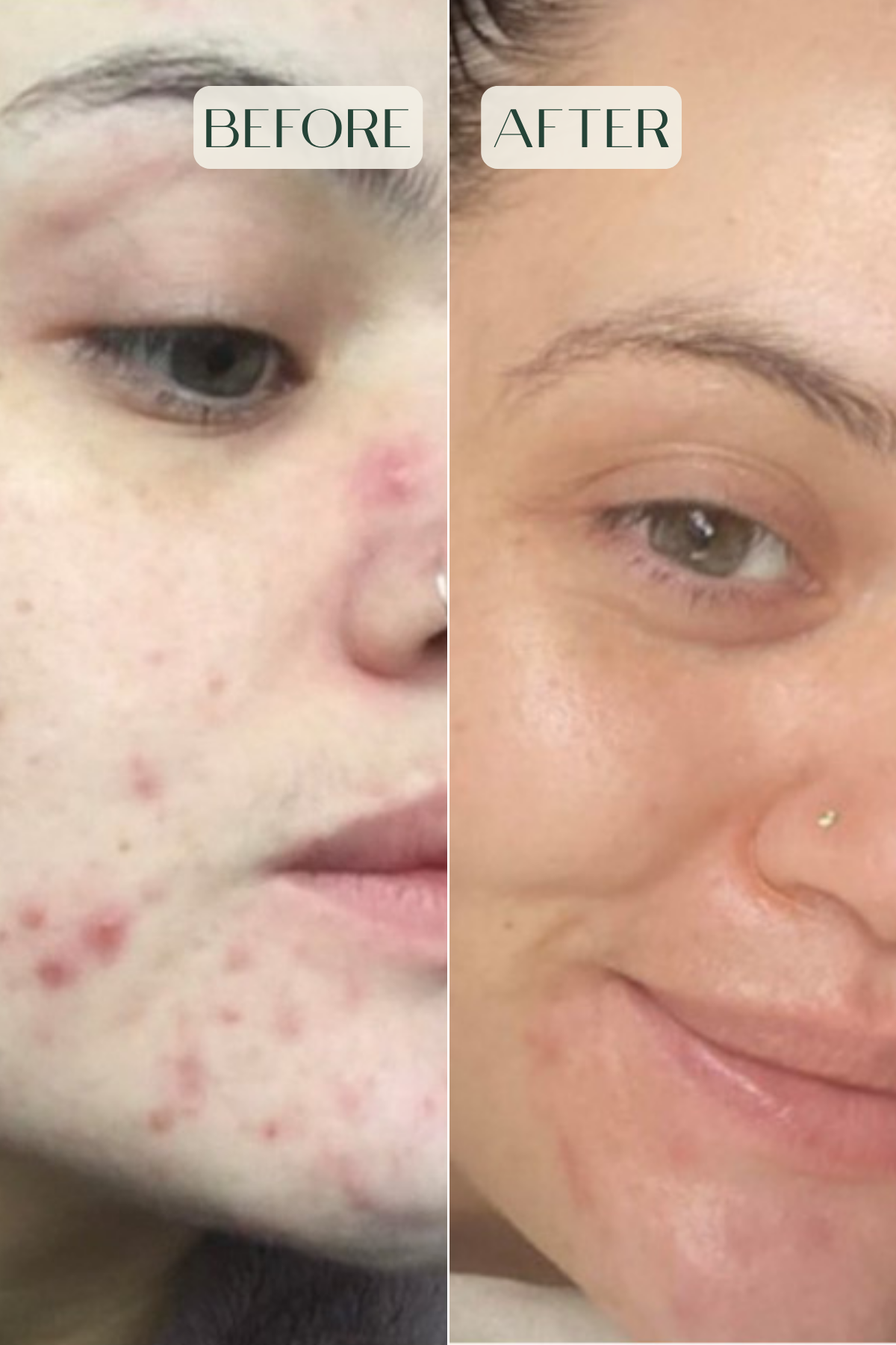 Acne & Oil-Control Serum: Skin Care Treatment For Acne Scars