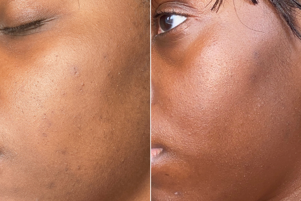 Bakuchiol Antioxidant Complex